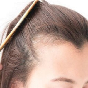 Women's hair loss experts at Natural Hair Company in Lisburn, County Antrim