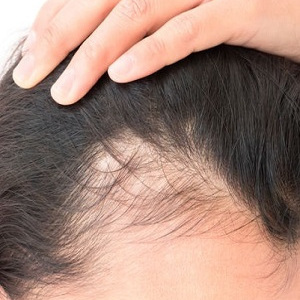 Hair loss solutions at Natural  Hair Company Salon in Lisburn, County Antrim