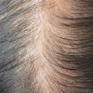 Hair loss experts in Lisburn, County Antrim